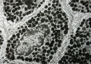 F, 1y. | urticaria pigmentosa F, 1y. | urticaria pigmentosa